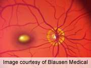Supplement aids age-related macular degeneration