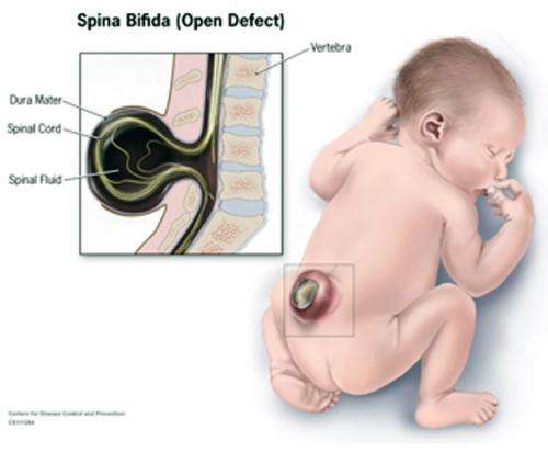 Surgery establishes penile sensation in men with spina bifida
