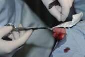 Sutures not superior to staples for closure in GI surgery