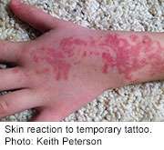 Temporary tattoos may leave permanent damage