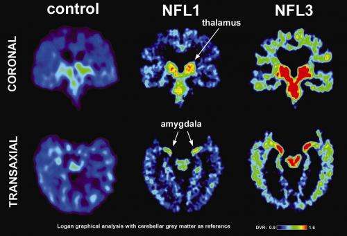 加州大学洛杉矶分校的研究首先图像concussion-related异常大脑蛋白质退休NFL球员
