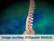 Updated guidelines available for lumbar spinal stenosis