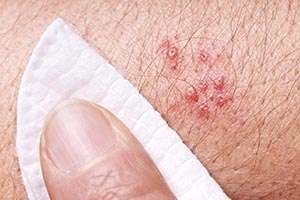 Use of biologic therapies for inflammatory diseases does not appear to increase risk of shingles