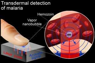Vapor nanobubbles rapidly detect malaria through the skin