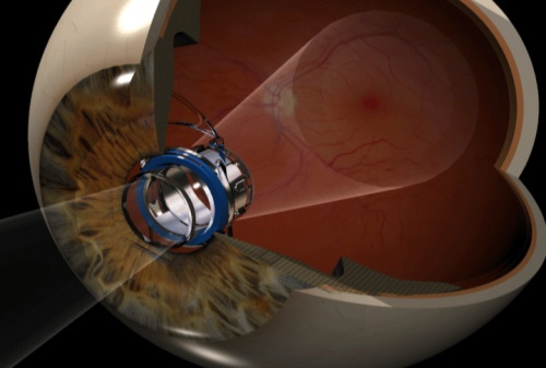 VCU Medical Center first in Virginia to implant telescope for macular degeneration