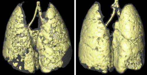 Visualizing how infection exacerbates lung disease