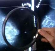 When breast cancer spreads to lungs, surgery may increase survival