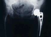 Women with lupus seem at higher risk for hip fractures