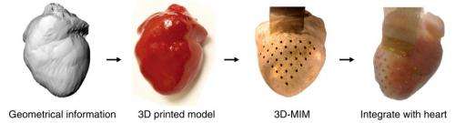 3-D heart sock could replace pacemaker
