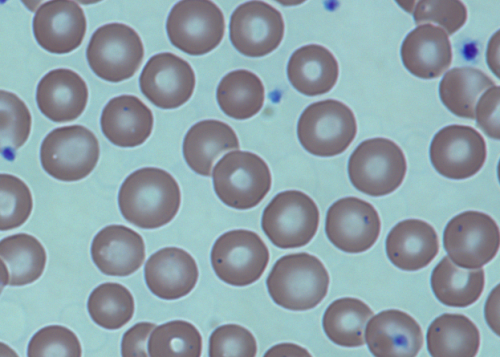 Adults stop anti-rejection drugs after stem-cell transplant reverses sickle cell disease