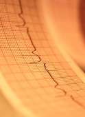 Atrial fibrillation may double risk for 'Silent strokes'