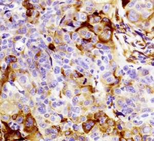 Cancer stem cells linked to drug resistance