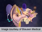 Cochlear implantation improves hearing in M&amp;eacute;ni&amp;egrave;re's disease