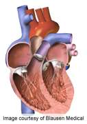 Considerable sudden death in hypertrophic cardiomyopathy