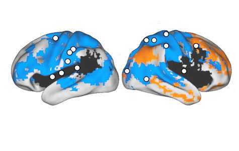 Damage to brain networks affects stroke recovery