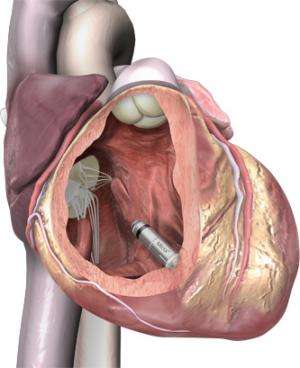 Heart expert sees pacemaker as cardiac management milestone
