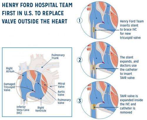 Henry Ford Hospital replaces heart valve outside the heart