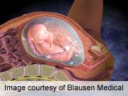 High-intensity ultrasound OK for cesarean scar pregnancy