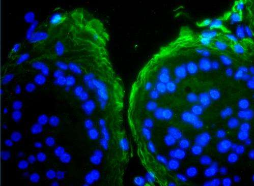 ‘Jekyll and Hyde’ molecule is key to new personalised medicine for prostate cancer