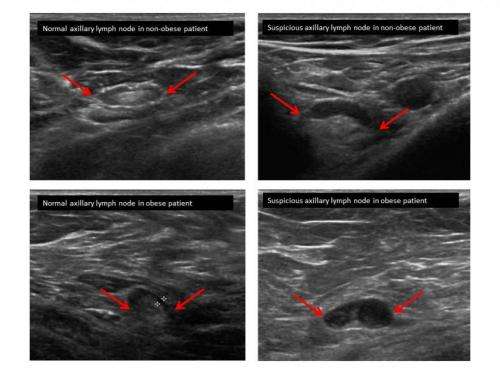Lymph node ultrasounds more accurate in obese breast cancer patients
