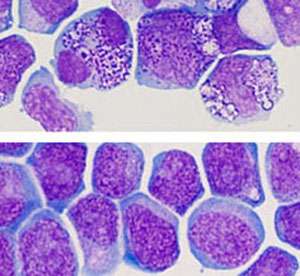 Major breakthrough in developing new cancer drugs: Capturing leukemic stem cells