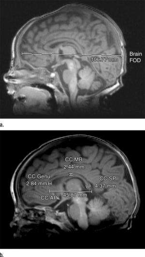 MRI shows brain abnormalities in late preterm infants