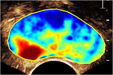 New method for prostate cancer detection can save millions of men painful examination