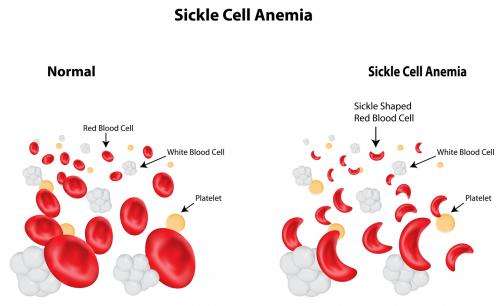 One day, science may cure sickle cell anaemia