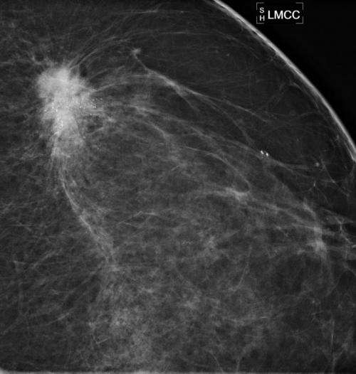 Risk-based screening misses breast cancers in women in their forties