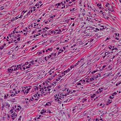 Second-most common breast cancer subtype may benefit from personalized treatment approach