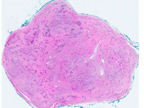 Singapore scientists discover genetic cause of common breast tumours in women