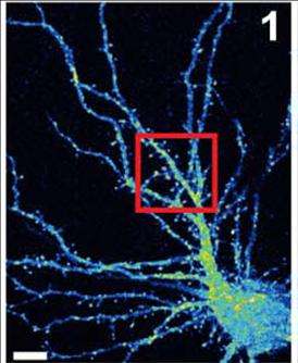 研究小组解释了突变的x连锁智力迟钝蛋白是如何损害神经元功能的