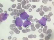 Scientists make breakthrough in understanding of rare blood cancer