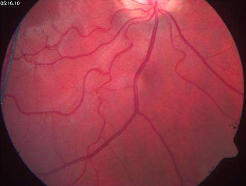 New technique analyses blood flow in glaucoma patients