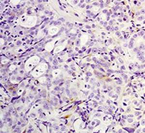 Cancer stem cells linked to drug resistance