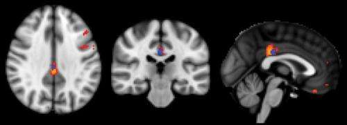 MRI technique detects evidence of cognitive decline before symptoms appear