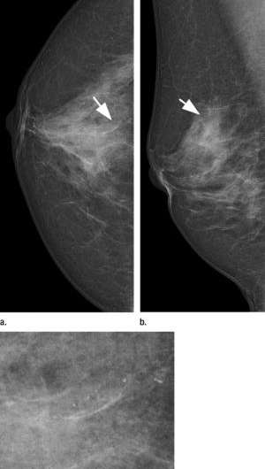 Novel technique increases detection rate in screening mammography