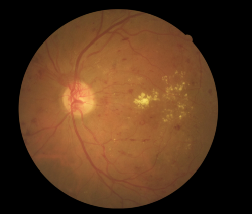 Researchers aiming to improve global standards for detection of leading cause of blindness