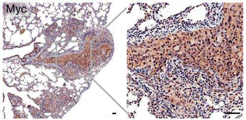 Scientists develop powerful new animal model for metastatic prostate cancer