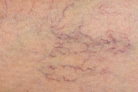 Study highlights preferred treatment for varicose veins