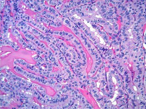Thyroid cancer genome analysis finds markers of aggressive tumors