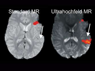 Ultra-high-field MRI reveals language centres in the brain in much more detail