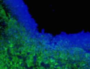 Scientists engineer toxin-secreting stem cells to treat brain tumors