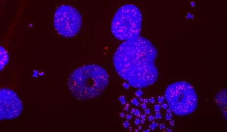 研究人员发现新的癌细胞脆弱性