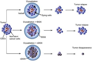 Researchers destroy cancer with cryoablation &amp;amp; nanoparticle-encapsulated anticancer drug
