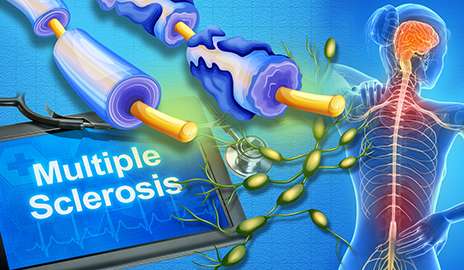 Scientists track origins of multiple sclerosis