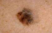 Experimental drug shows early promise for some cases of advanced melanoma