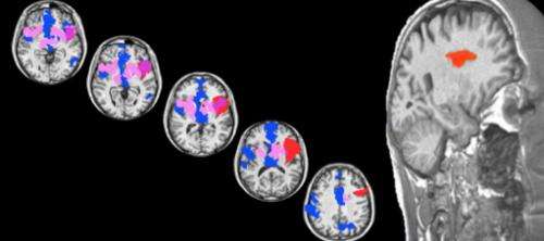 Researchers find brain’s ‘sweet spot’ for love in neurological patient