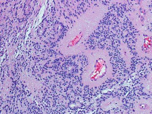 Gene sequencing project discovers common driver of a childhood brain tumor