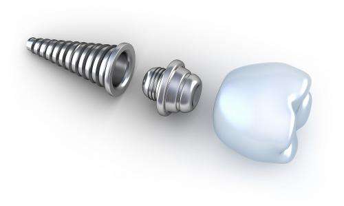 New materials for better, stronger and cheaper dental implants
